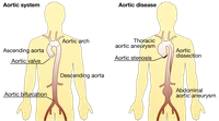 Aortic disease