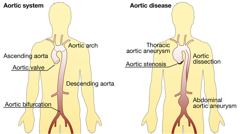 Aortic disease Aortic disease