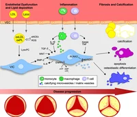 Phases of calcific aortic valve disease -CAVD.png